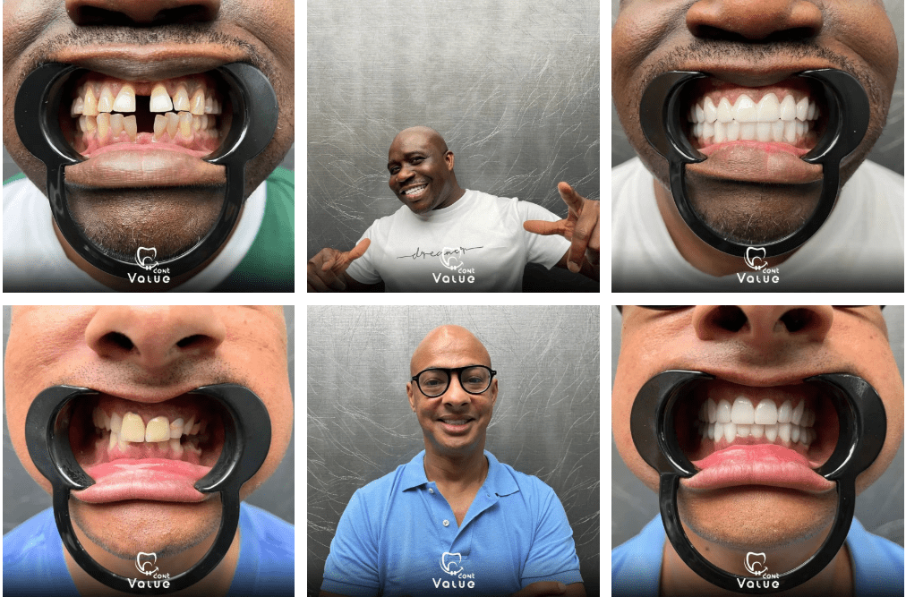 Hollywood Smile in Istanbul: 2025 Price Guide at Valuedent Clinic 1 gal10