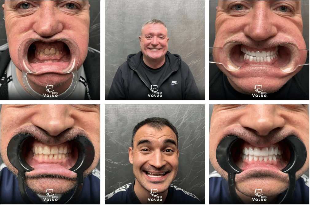 Everything You Need to Know About Getting a Hollywood Smile in Istanbul 1 hollywood smile istanbul turkey